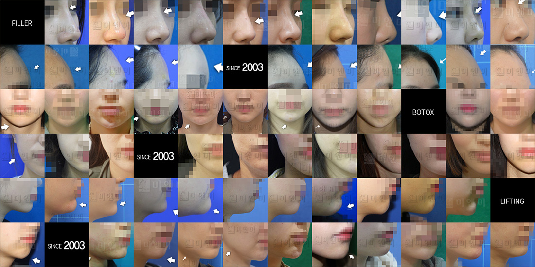 SINCE 2003 MI&MI, 시술후사진모음 창원쫑알주사,마산쫑알주사