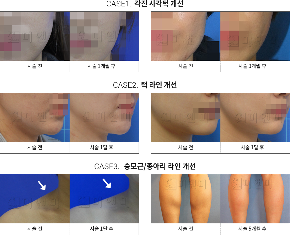 시술전후사진 승모근 보톡스 : 각진 사각턱 개선,턱 라인 개선,승모근/종아리 라인 개선 창원승모근보톡스,마산승모근보톡스