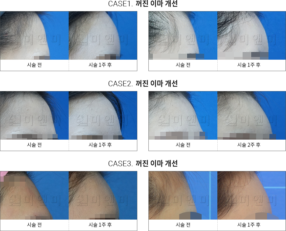 시술전후사진 이마필러 : 무턱개선 창원이마필러,마산이마필러