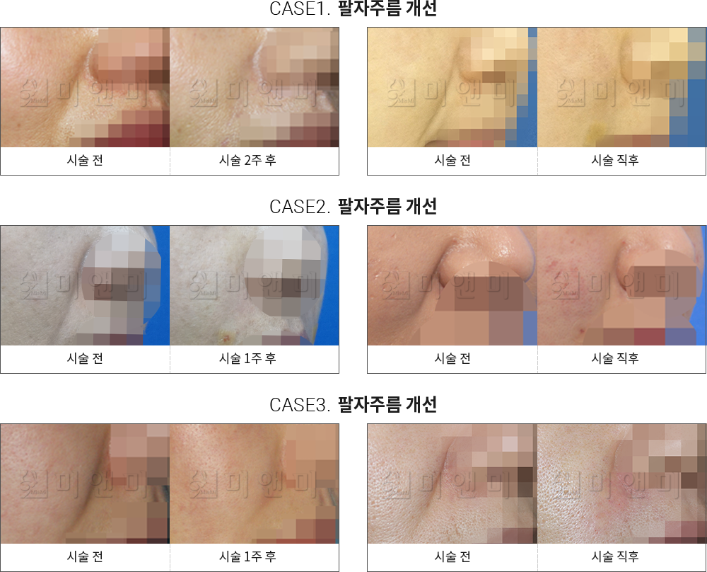 시술전후사진 팔자필러 : 팔자주름 개선 창원팔자필러,마산팔자필러